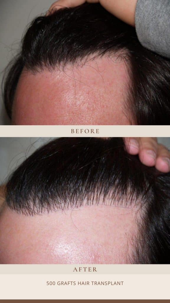 The Pros And Cons Of A Graft Hair Transplant