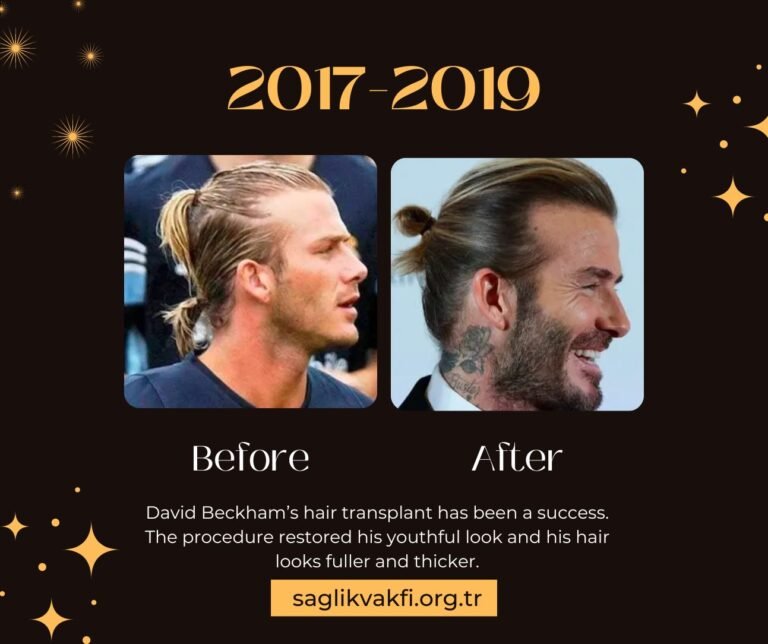 David Beckham Hair Transplant See How He Transformed His Look