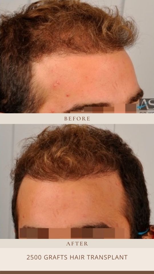 2500 GRAFTS before after