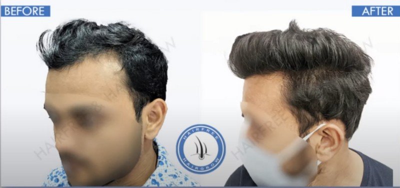 2500 GRAFTS before after