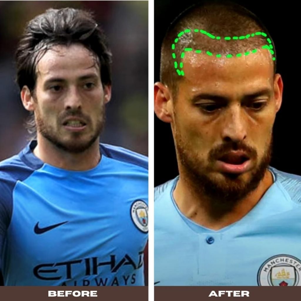 David Silva Hair Transplant