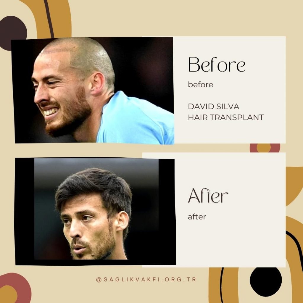 David Silva Hair Transplant after before