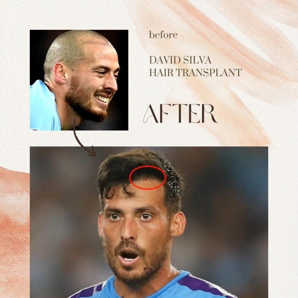 David Silva Hair Transplant: What the Expect