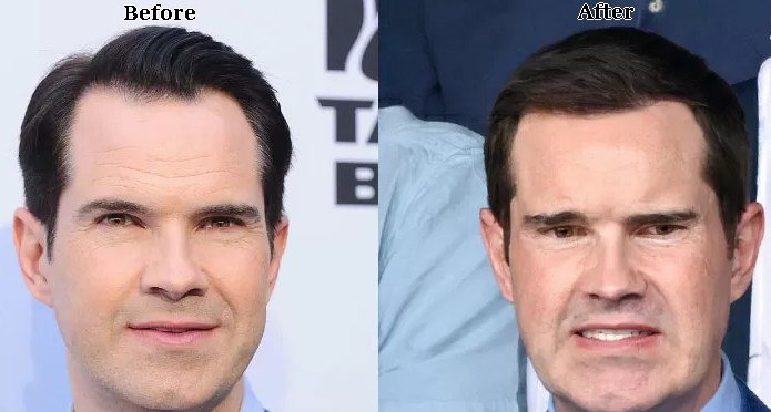 Jimmy Carr hair transplant before after