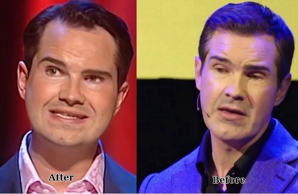 Jimmy Carr Hair Transplant