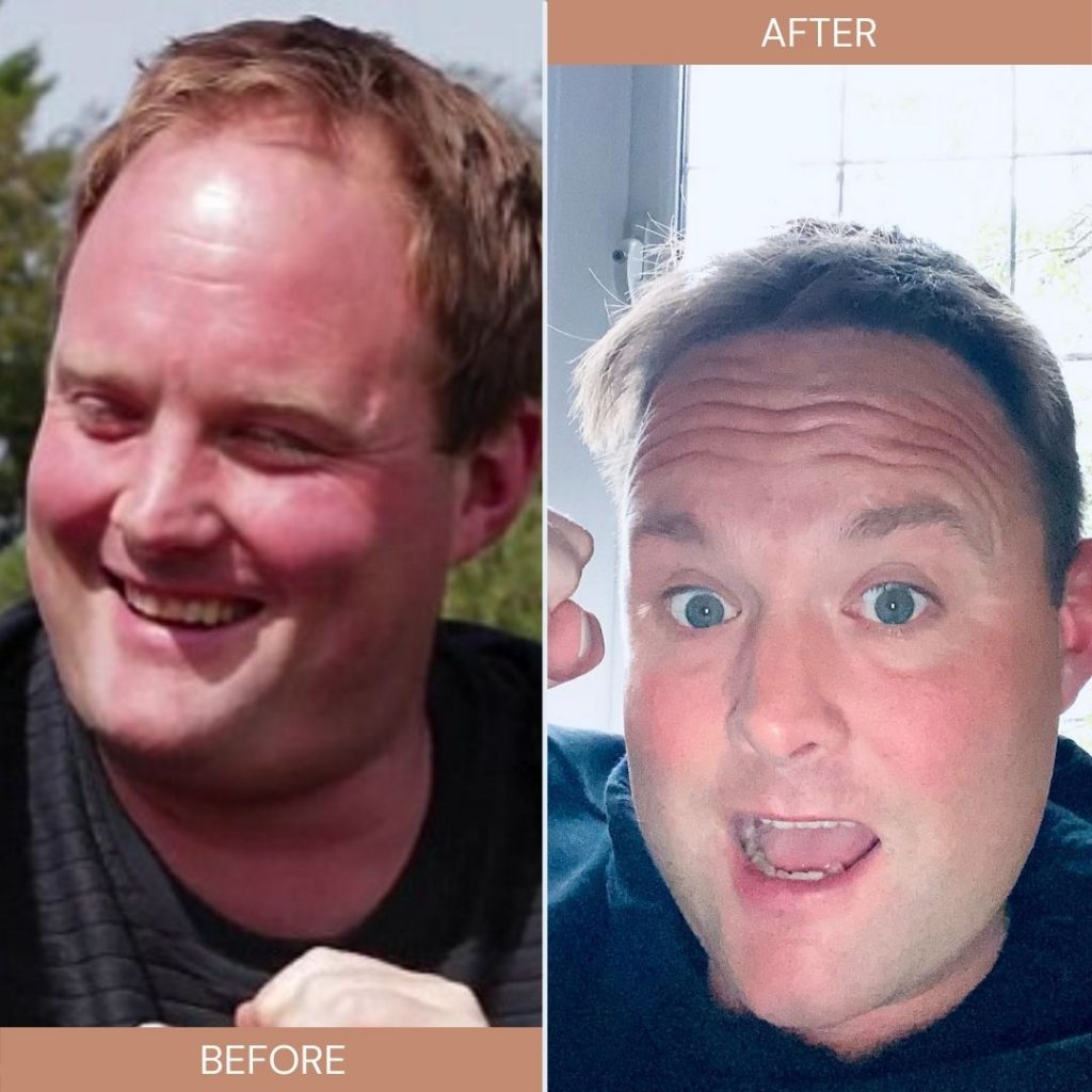 Peter Tubes Dale's Hair Transplant Before After