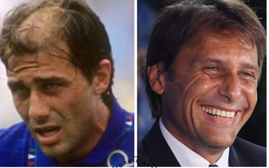 Antonio Conte hair transplant