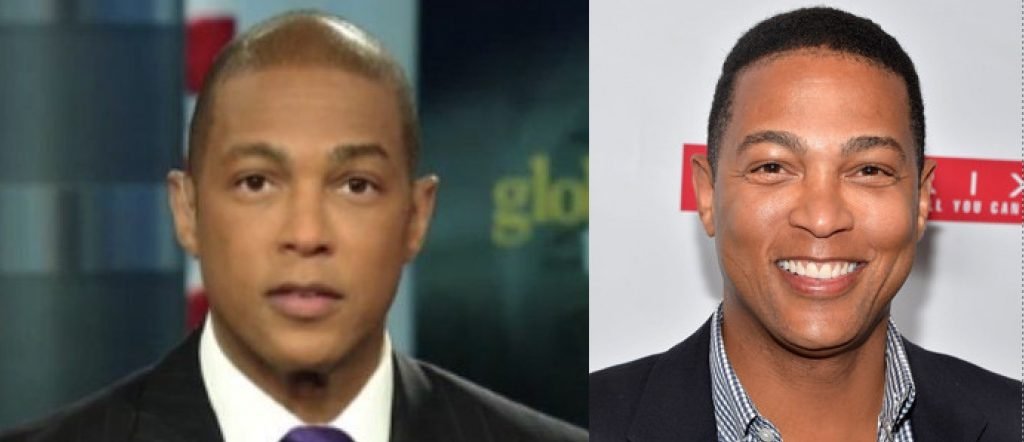 Don Lemon Hair Transplant What You Need to Know