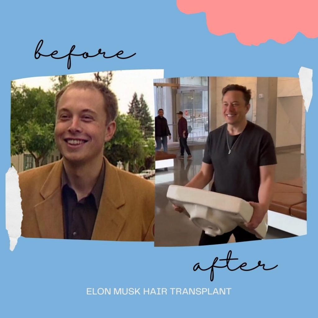 Elon Musk's hair before and after