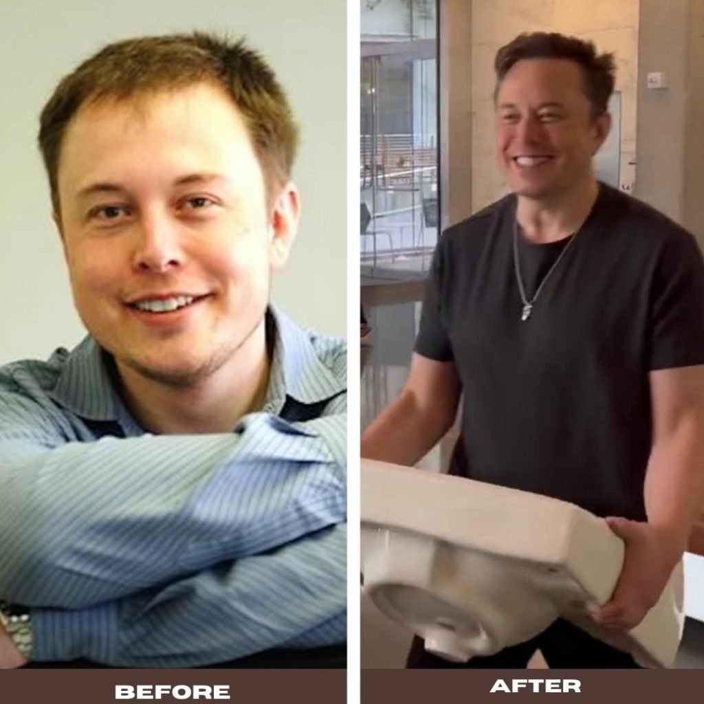 Did Get Elon Musk A Hair Transplant Hair Restoration Questions And Answers Hair Restoration 7888