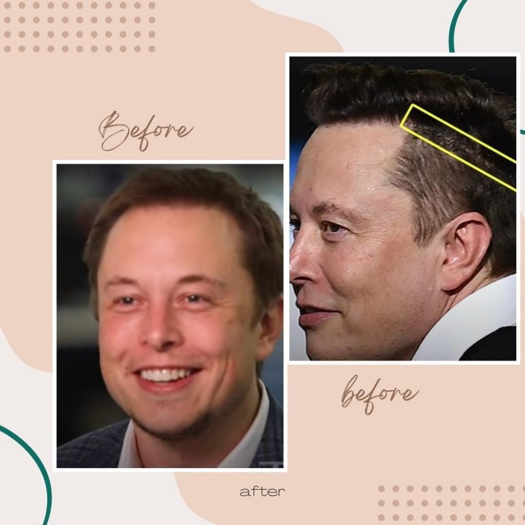 elon musk hair transplant