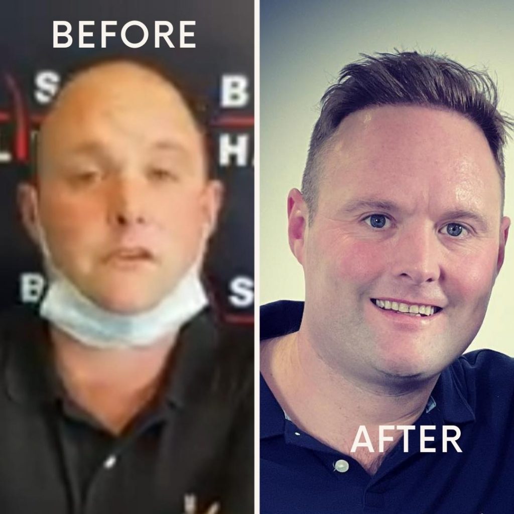 Peter Tubes Dale's Hair Transplant Before After