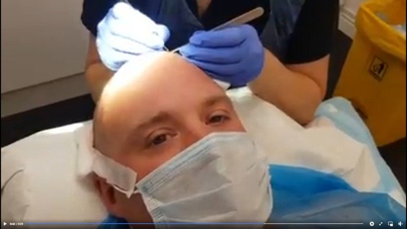 Tubes Hair transplant surgery