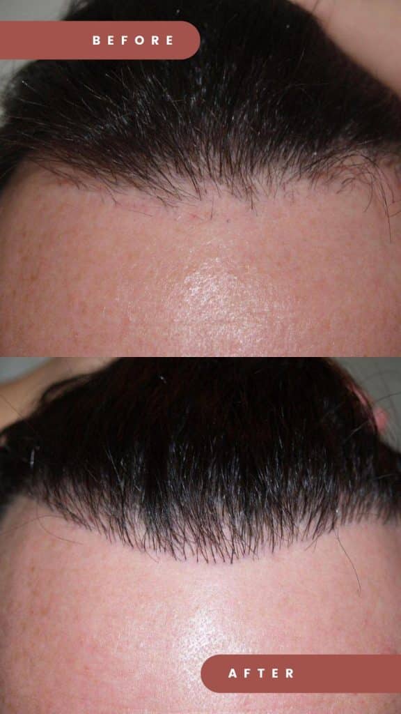 500 grafts before AFTER 