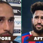 Andros Townsend hair transplant