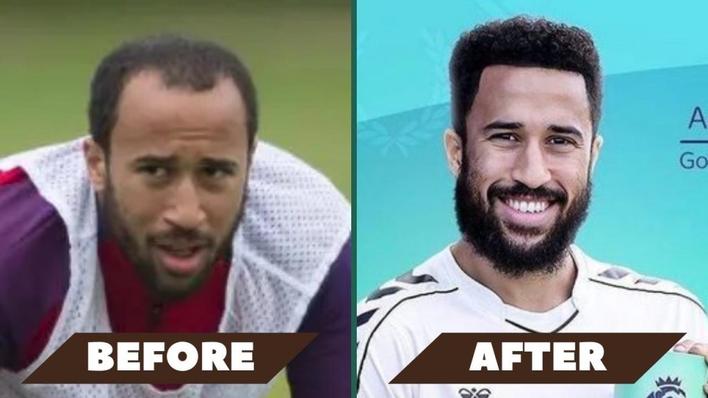 Andros Townsend hair transplant before after