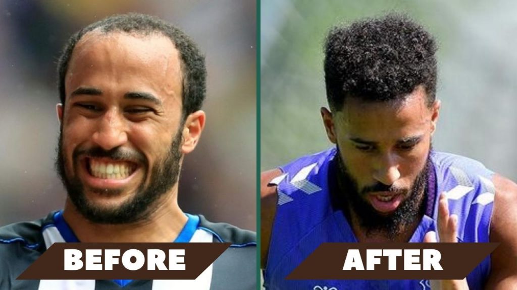 Andros Townsend hair transplants