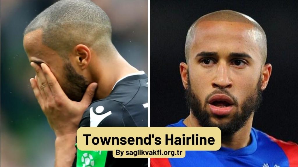 Andros Townsend hairline