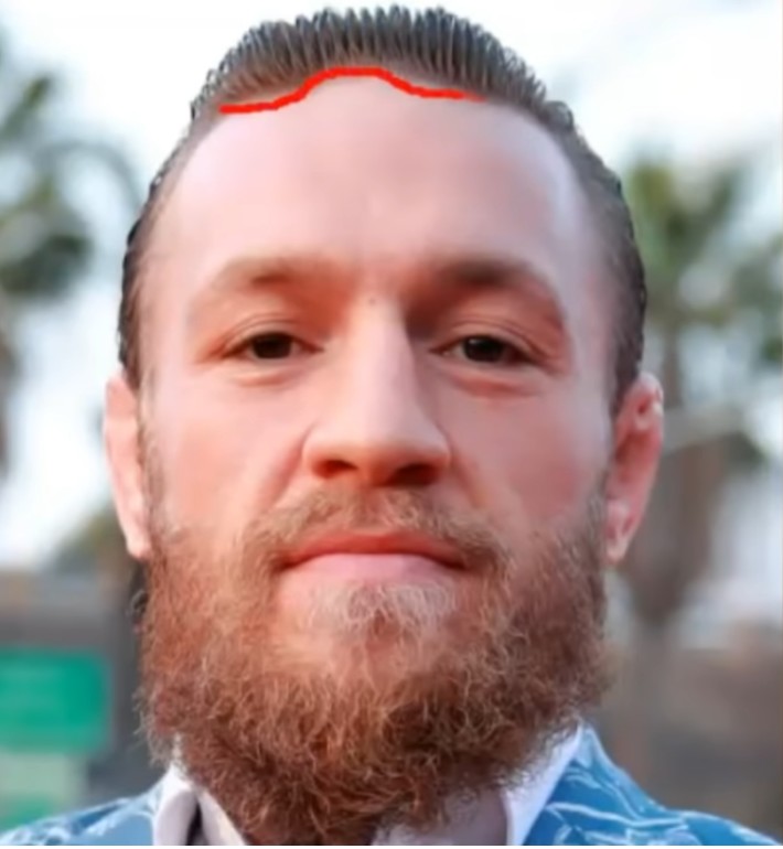 Conor McGregor's Hair transplant