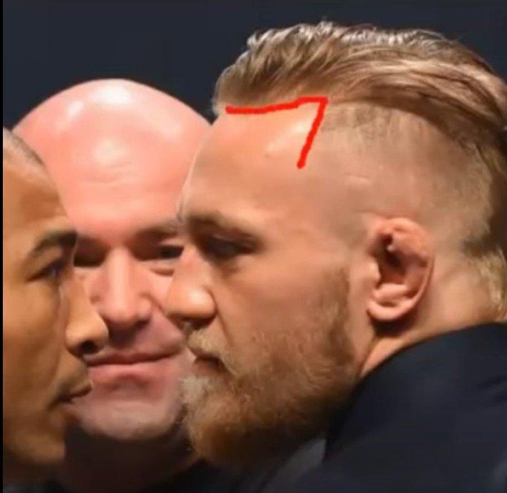 Conor McGregor's Hair transplant