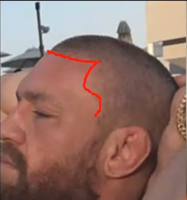 Conor McGregor's Hair transplant 