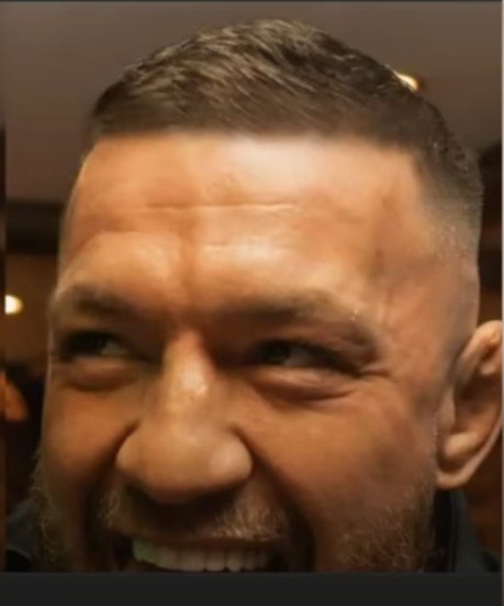 Conor McGregor's Hair transplant