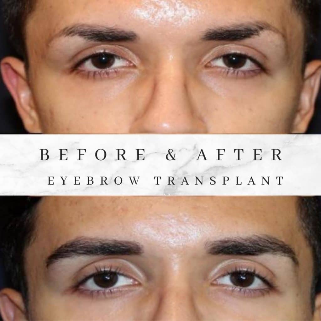 Eyebrow Transplant Results