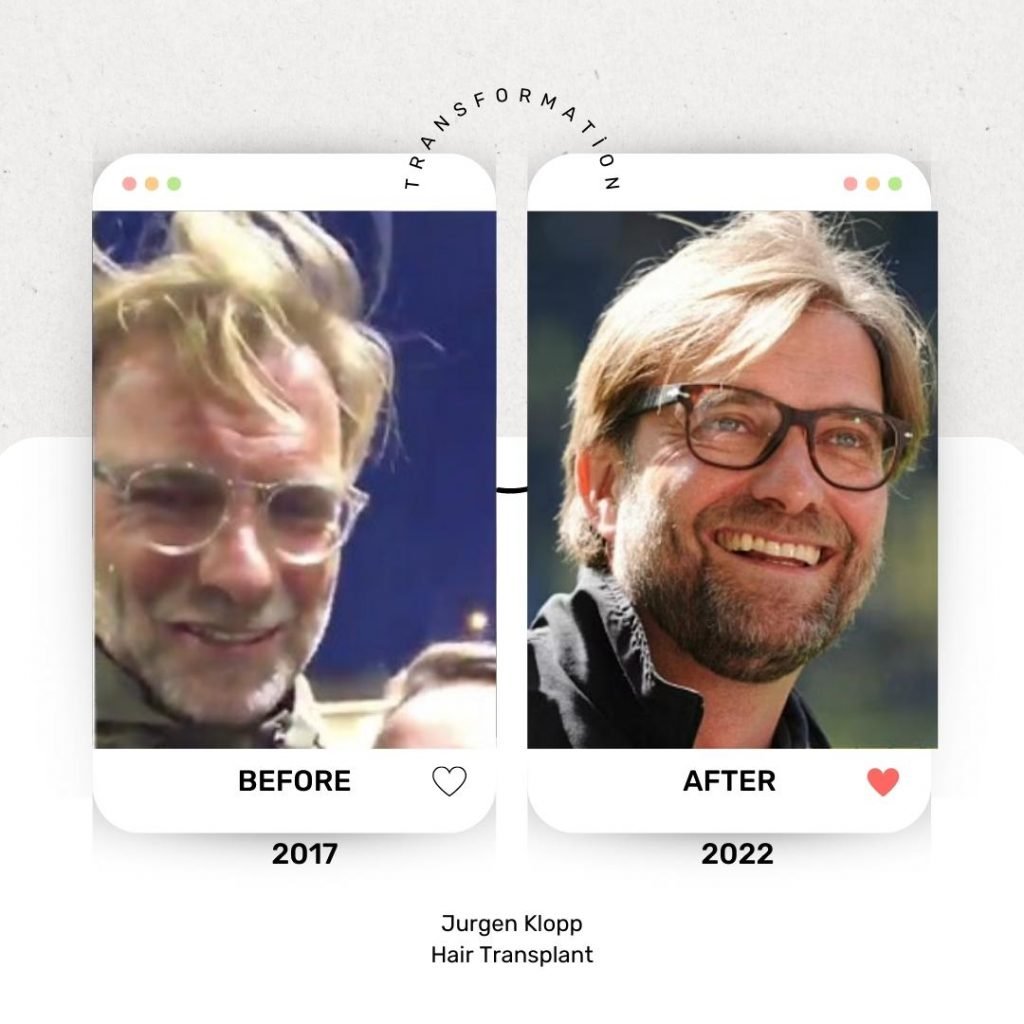 Jurgen Klopp Hair Transplant