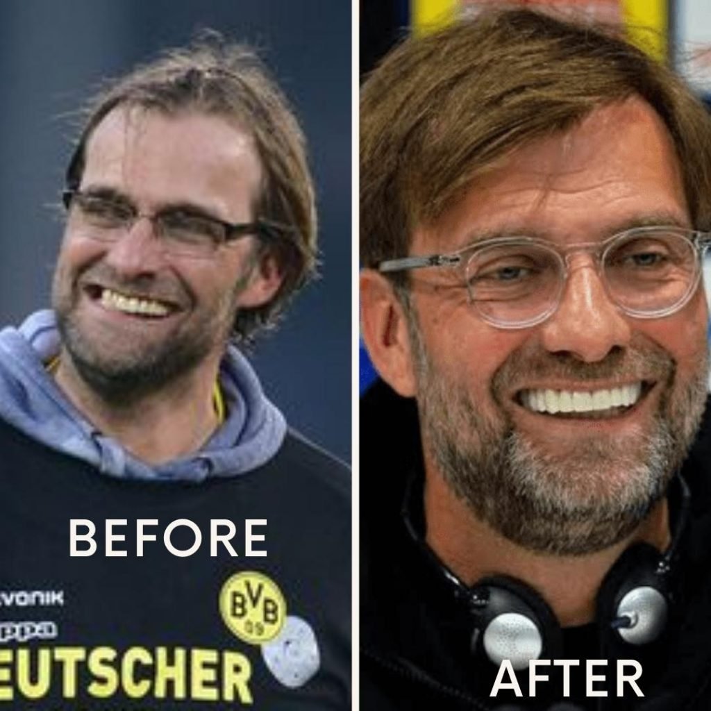 Jurgen Klopp Hair Transplant