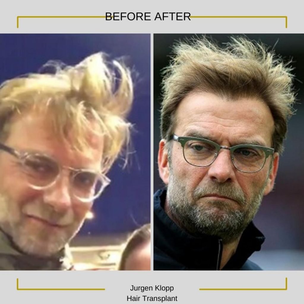 Jurgen Klopp Hair Transplant