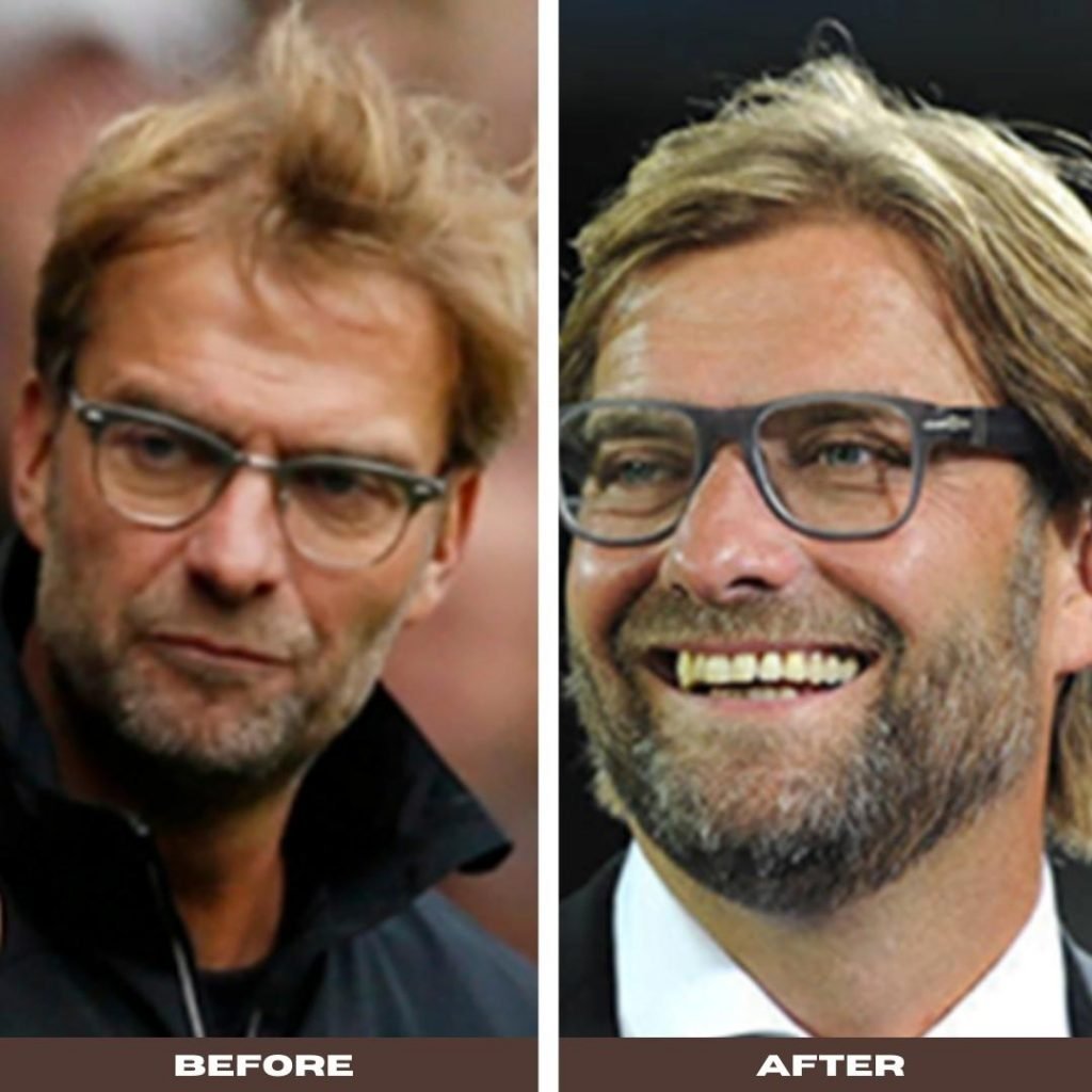 Incredibly Pictures Of Jurgen Klopps New Hair Transplant