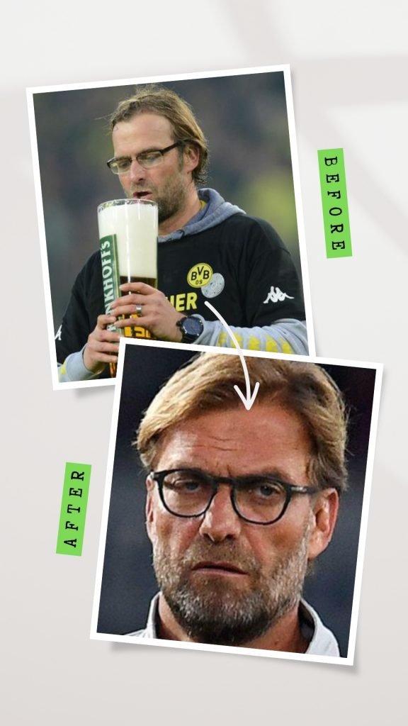 Jurgen Klopp Hair Transplant