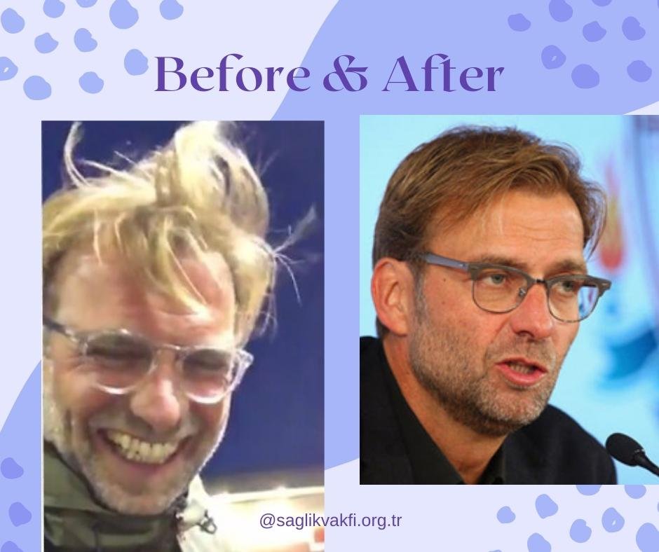 Jurgen Klopp Hair Transplant