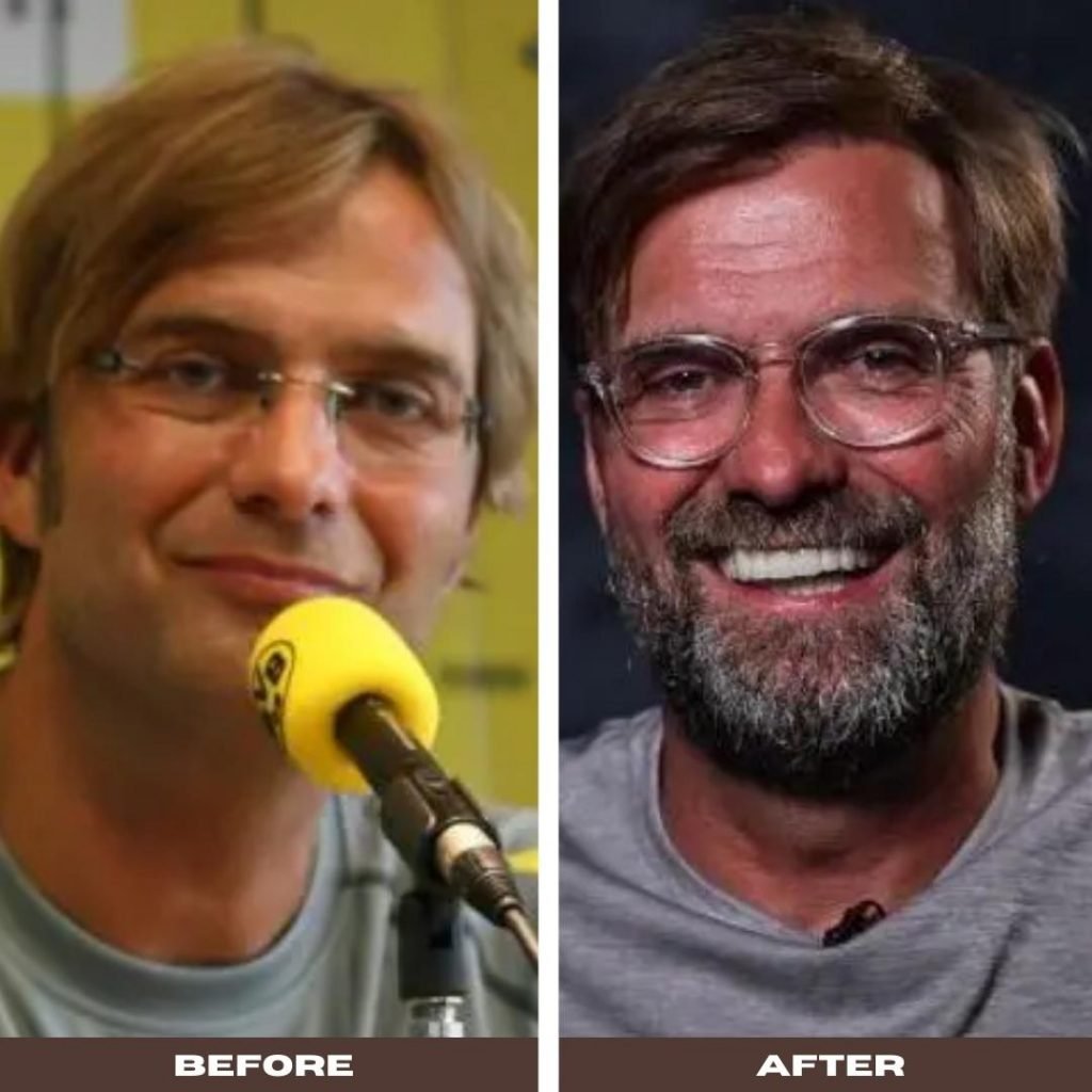 Jurgen Klopp Hair Transplant