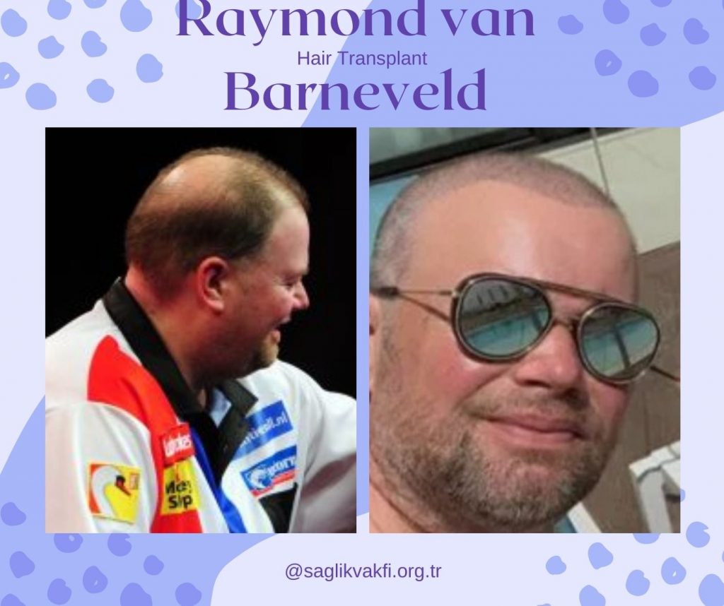 Raymond van Barneveld Before After