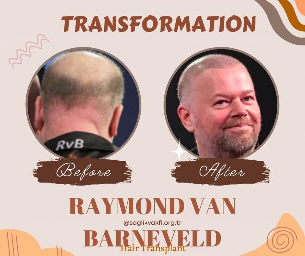 Raymond van Barneveld Before After 