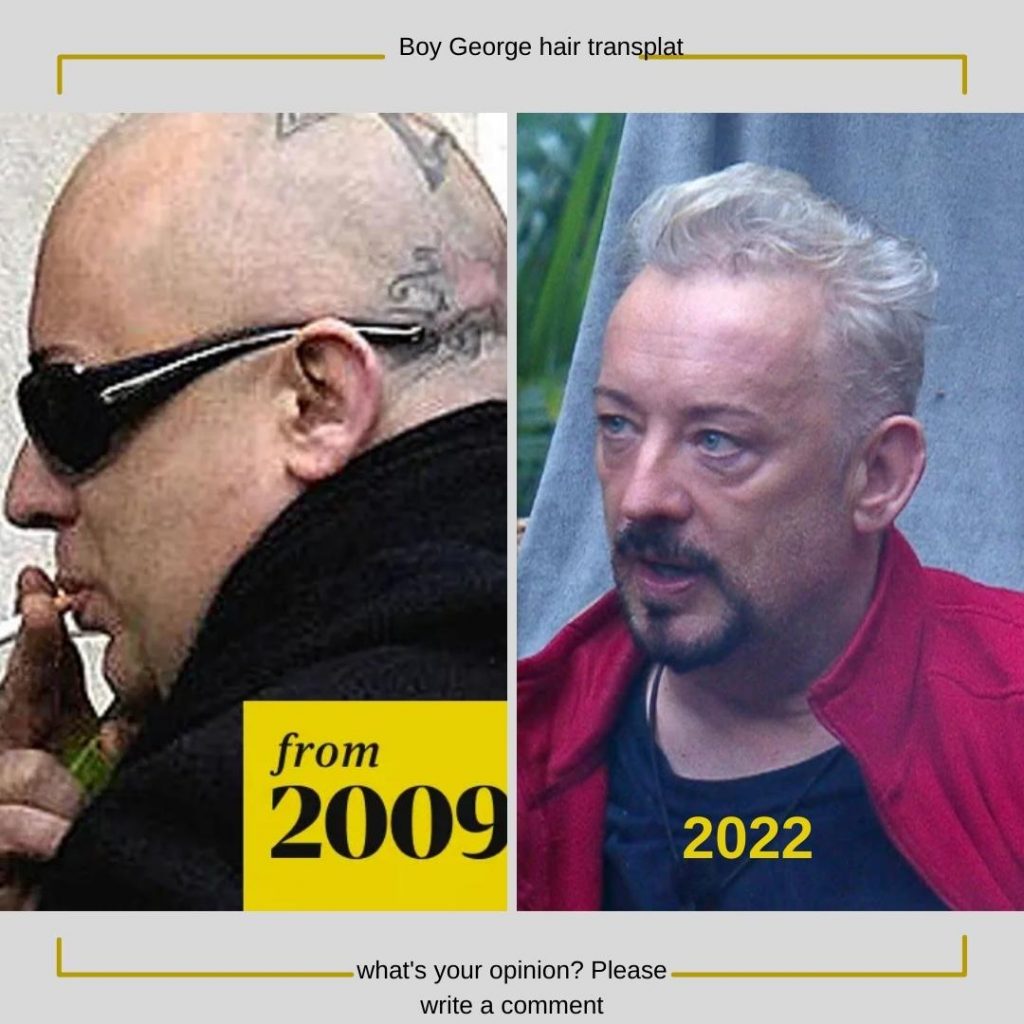 boy-george-before-after-hair-transplant