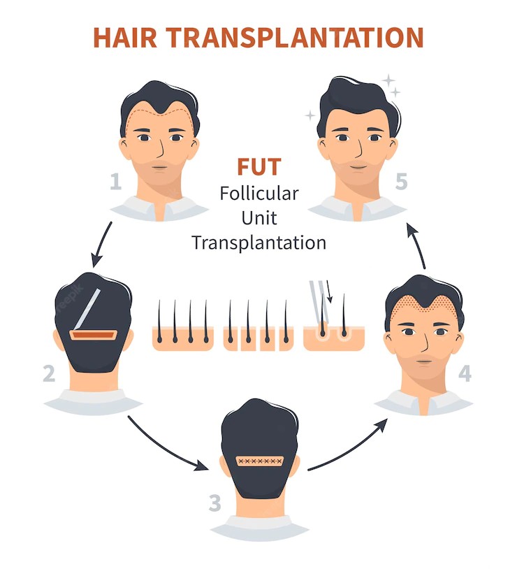 fut-hair-transplant
