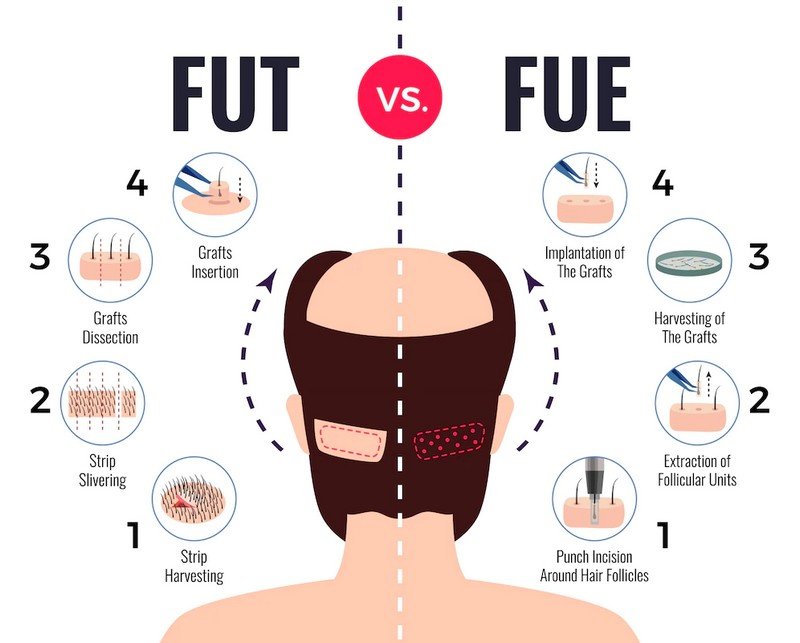 fut vs fue