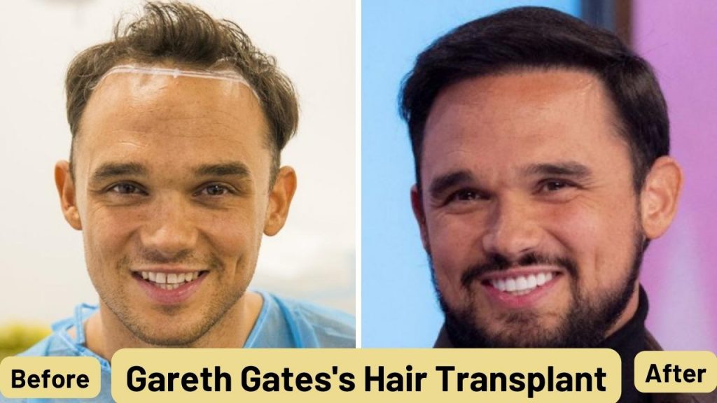 gareth gates hair transformation