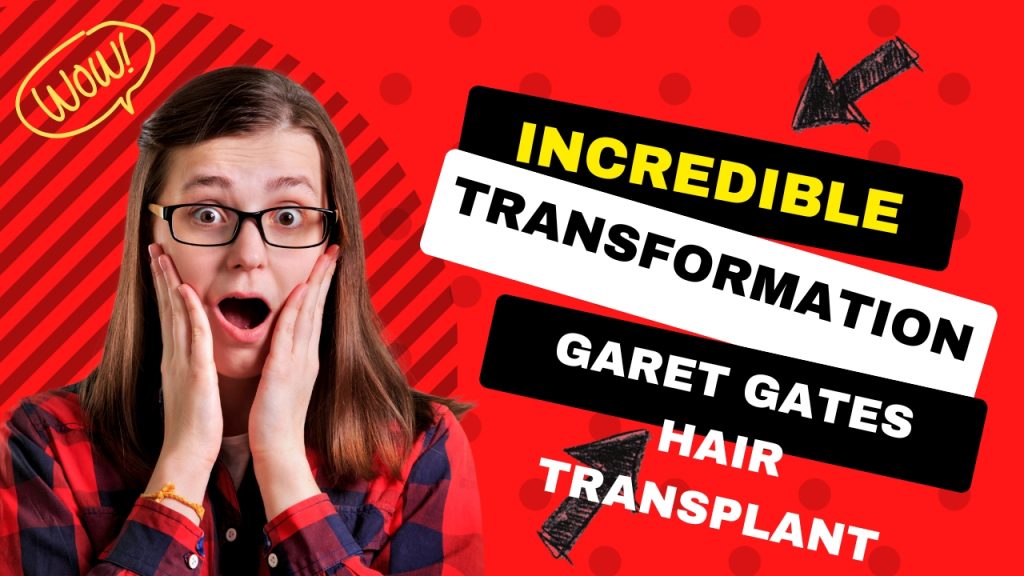 gareth gates hair transplant indcredible