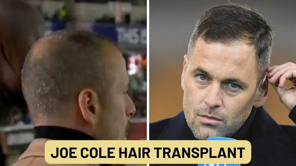 joe cole hair transplant before after