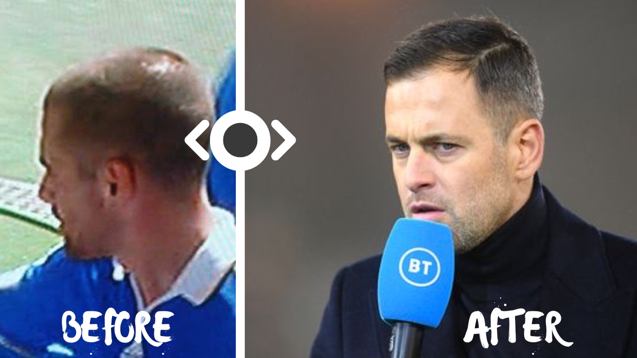 A Closer Look At Joe Cole's Hair Transplant Journey