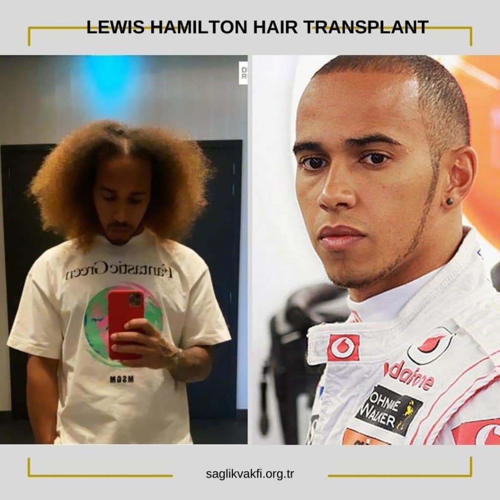 lewis hamilton hair transplant