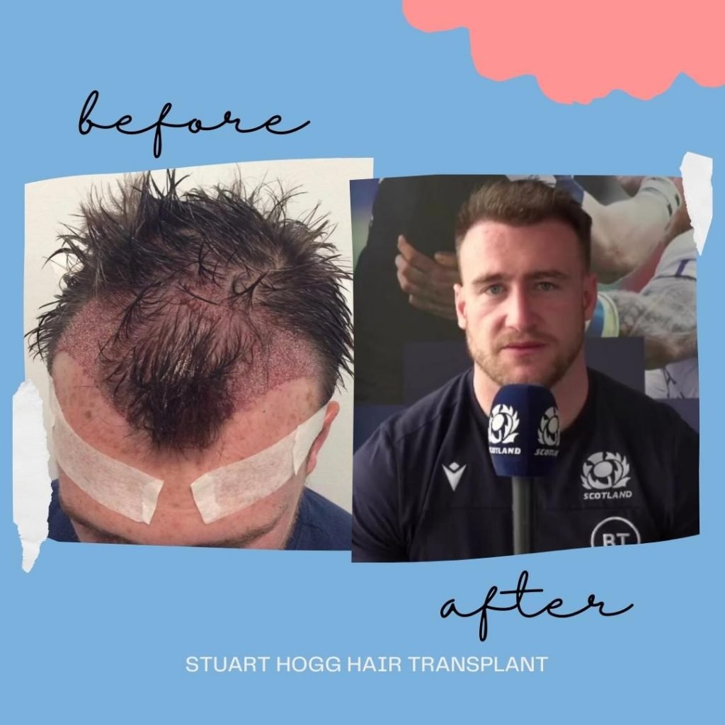 Stuart Hogg's Hair Transplant