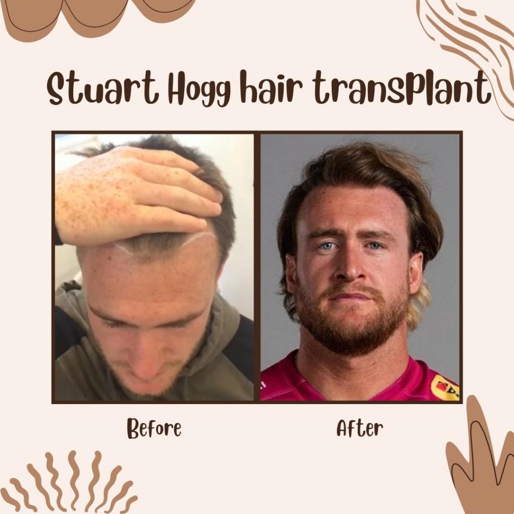 Stuart Hogg's Hair Transplant