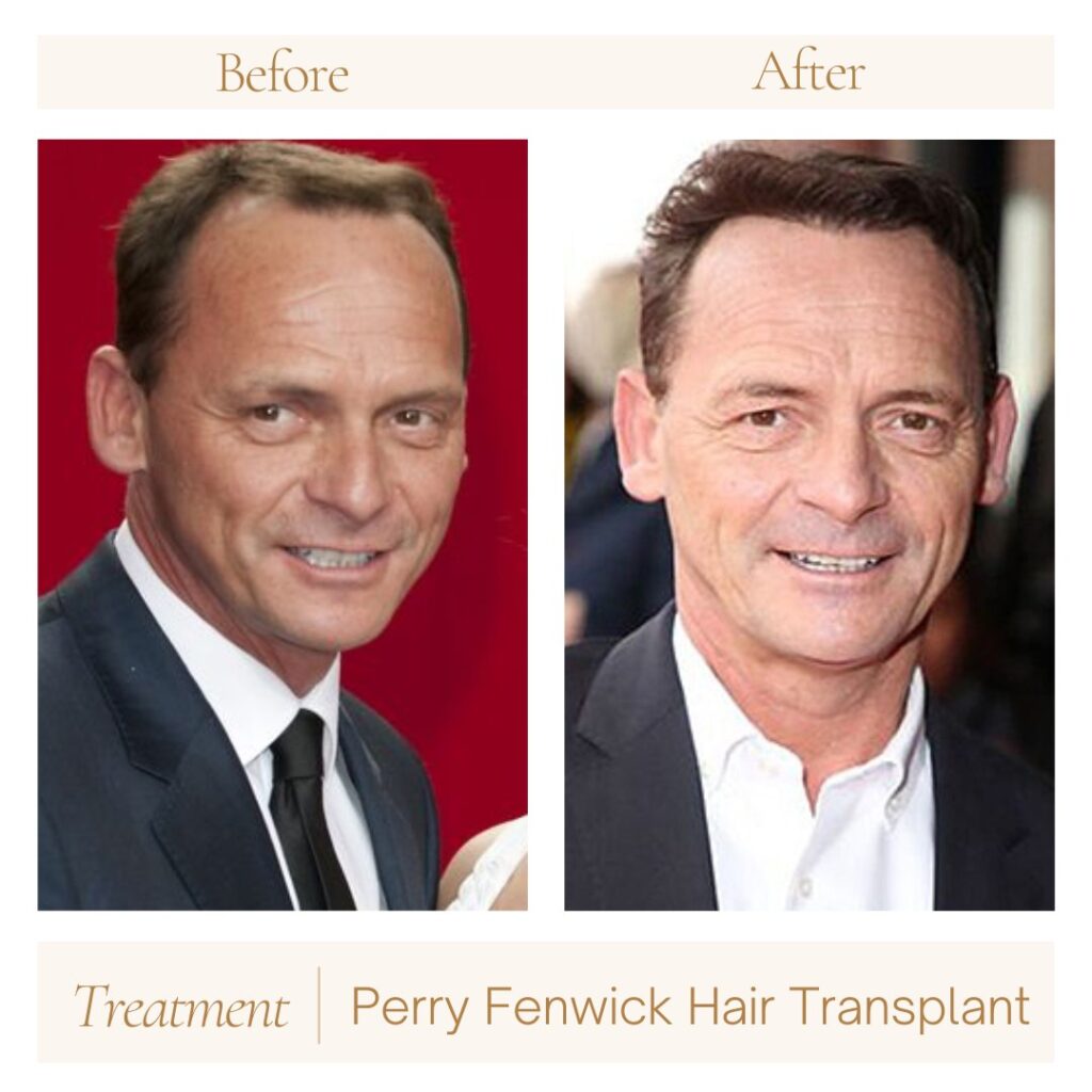 Perry Fenwick hair before after