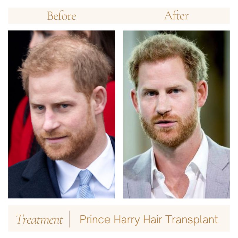 prince harry hair before after