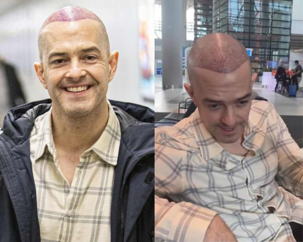 Lee Mead's Hair Transplant