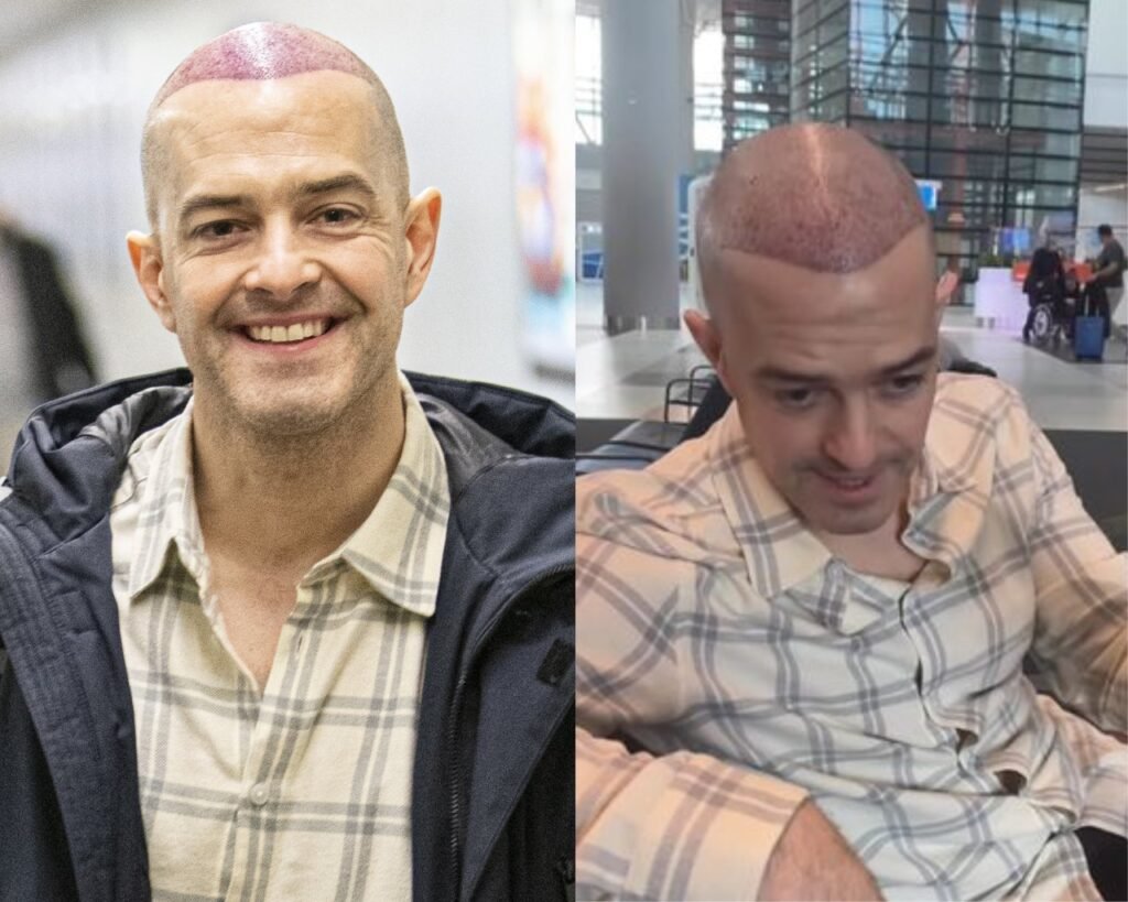 Lee Mead's Hair Transplant Journey: A Success Story